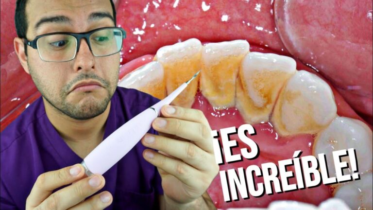 Guía Paso a Paso para Eliminar la Placa Dental Eficazmente