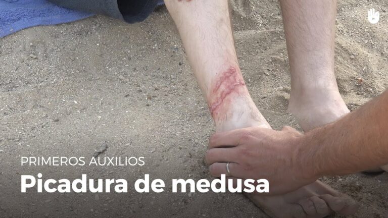 Guía Efectiva: Cómo Quitar los Tentáculos de Medusa Tras una Picadura