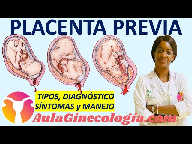 Guía Completa sobre el Tratamiento de la Placenta Previa: Pasos y Precauciones