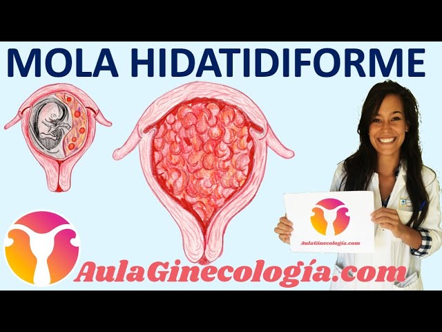 Guía Completa sobre la Anatomía Patológica de la Mola Hidatiforme: Síntomas y Diagnóstico