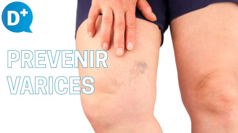 5 Consejos Efectivos para Prevenir las Varices: Guía Completa