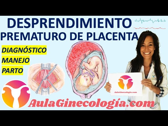 Manejo y Prevención del Desprendimiento Prematuro de Placenta: Guía Actualizada