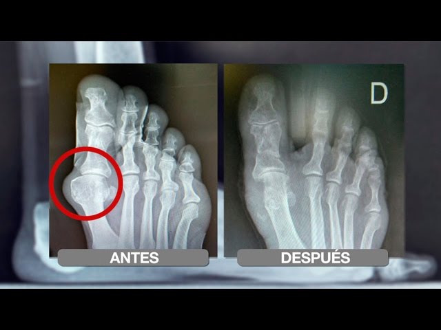 Guía Completa para el Tratamiento de Juanetes: Cómo Curarlos Eficazmente