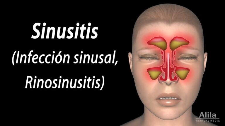 Síntomas y Señales de Alerta: Entendiendo la Sinusitis Aguda