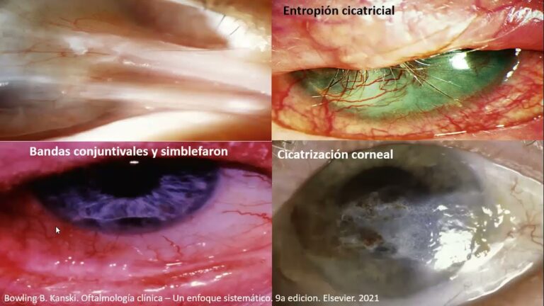 Guía Definitiva: Tratamiento Seguro para Quemaduras Químicas en los Ojos