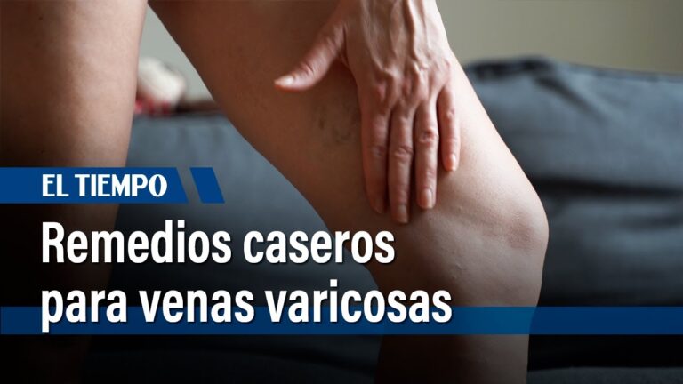 Tratamiento Natural para Varices: 10 Remedios Caseros Efectivos